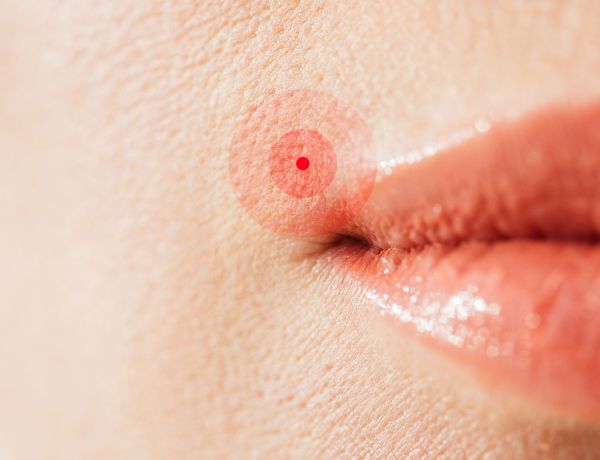 Nahaufnahme von Lippen mit Herpesbläschen als Darstellung einer Infektion.