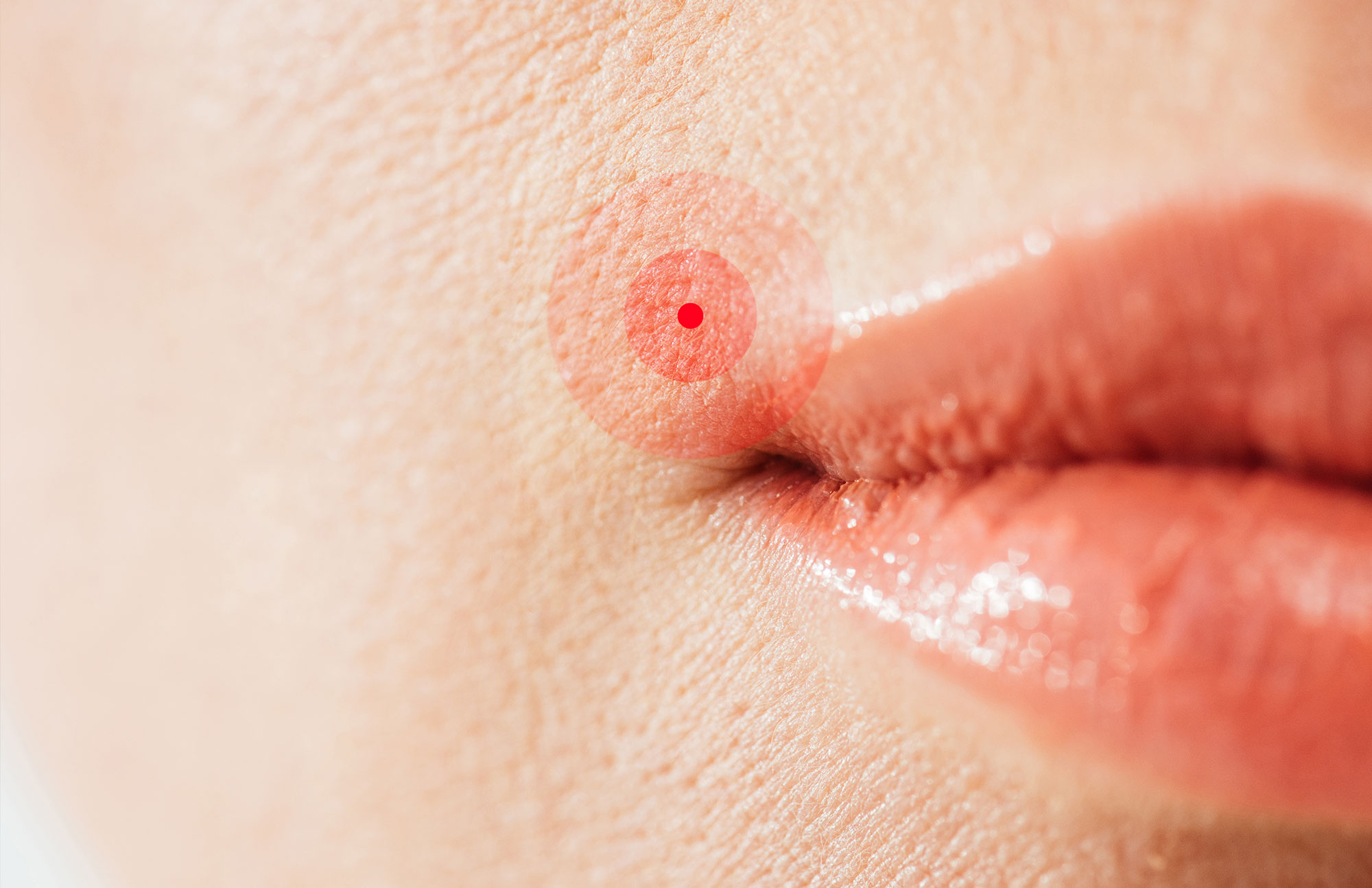 Nahaufnahme von Lippen mit Herpesbläschen als Darstellung einer Infektion.